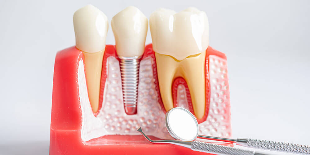 Dental Implants Dorval