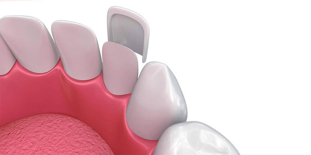 Dental Veneers Dorval