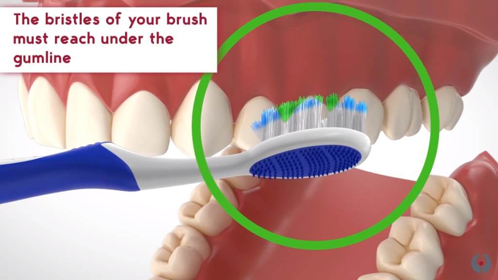 Sulcular brushing technique